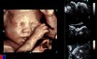 Трехмерное УЗИ от NVIDIA и Siemens Healthcare