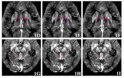 Высокоточный метод ранней диагностики болезни Альцгеймера разработан учёными ПНИПУ