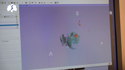 The Latest 3D Technology in Oncology: Sechenov University Implements Preoperative Breast Modeling