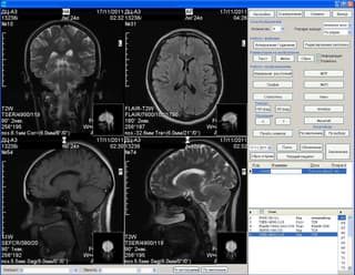 Pacientes con depresión aprendieron a identificar mediante resonancia magnética