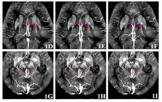 High-Precision Method for Early Diagnosis of Alzheimer's Disease Developed by PNRPU Scientists