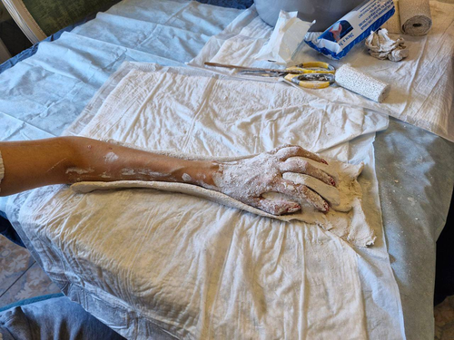 The photograph was taken during the process of obtaining a plaster cast of the hand. With flexor contracture of the hand, the hand is in the "pinch" position. To design an orthosis, you need to have a 3D model of the patient's hand in a straightened, natural position. The patient cannot hold the hand in this position on their own, so plaster bandages were used.