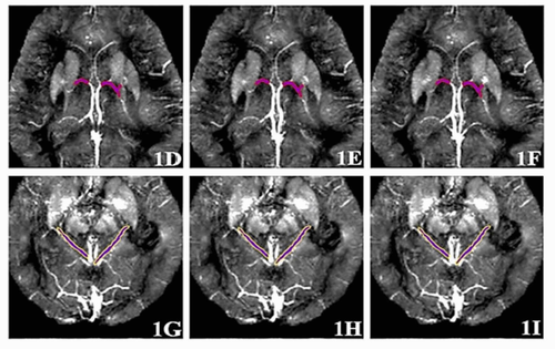 Tomographic images of brain veins