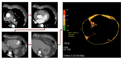 Tomografía computarizada del corazón con análisis de grasa epicárdica mediante el trazado manual del epicardio en las imágenes - del archivo de investigadores del Instituto de Investigación de Cardiología del Centro Médico Nacional de Investigación de Tomsk