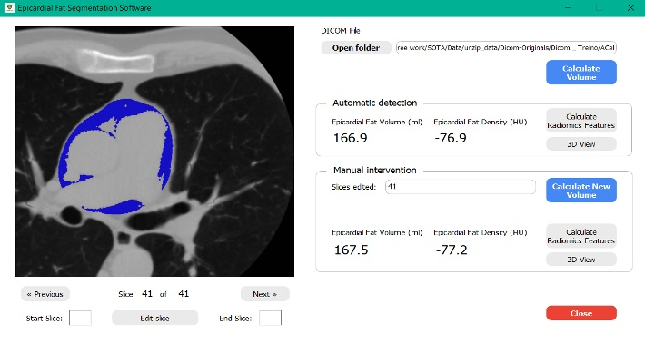 Интерфейс программы EPIFAT: результаты автоматического анализа эпикардиальной жировой ткани
