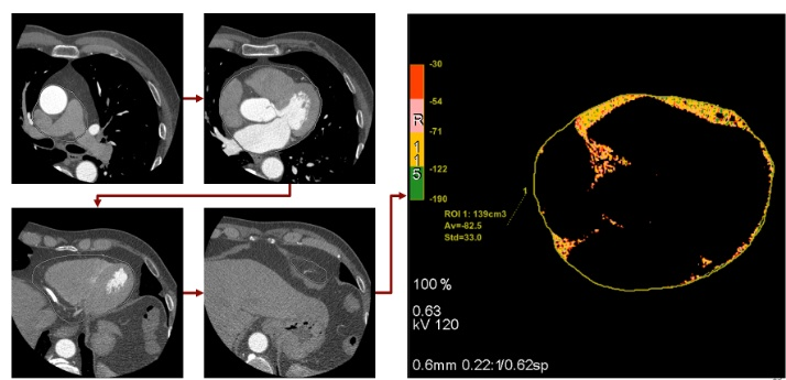 Компьютерная томография сердца с анализом эпикардиального жира с помощью ручного обведения эпикарда на изображениях - из архива исследователей НИИ кардиологии Томского НИМЦ