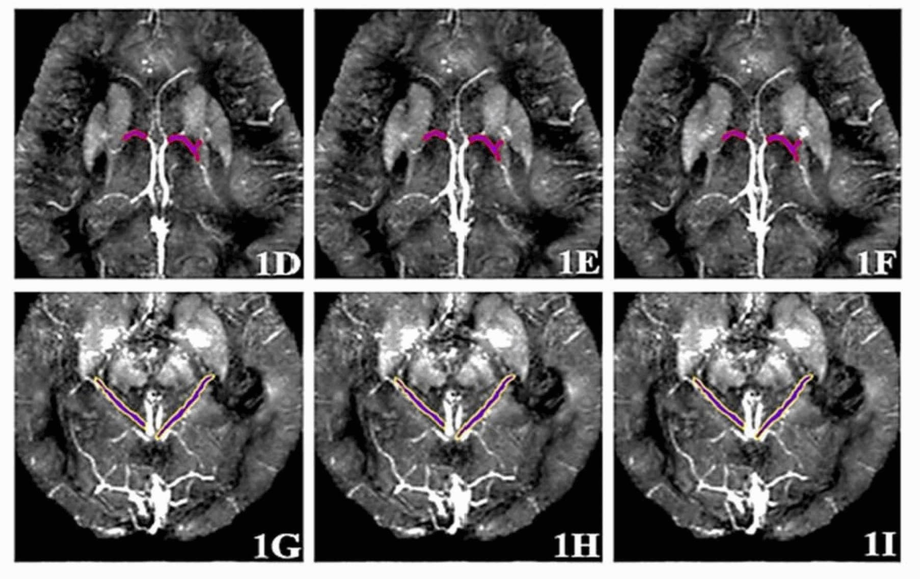 Tomographic images of brain veins